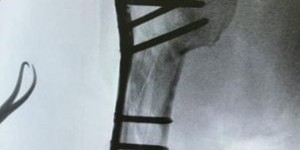 【EV扑克】林志穎車禍5個月「重新開始健身」！　首秀鈦合金手臂：需要訓練