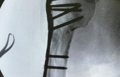 【EV扑克】林志穎車禍5個月「重新開始健身」！　首秀鈦合金手臂：需要訓練